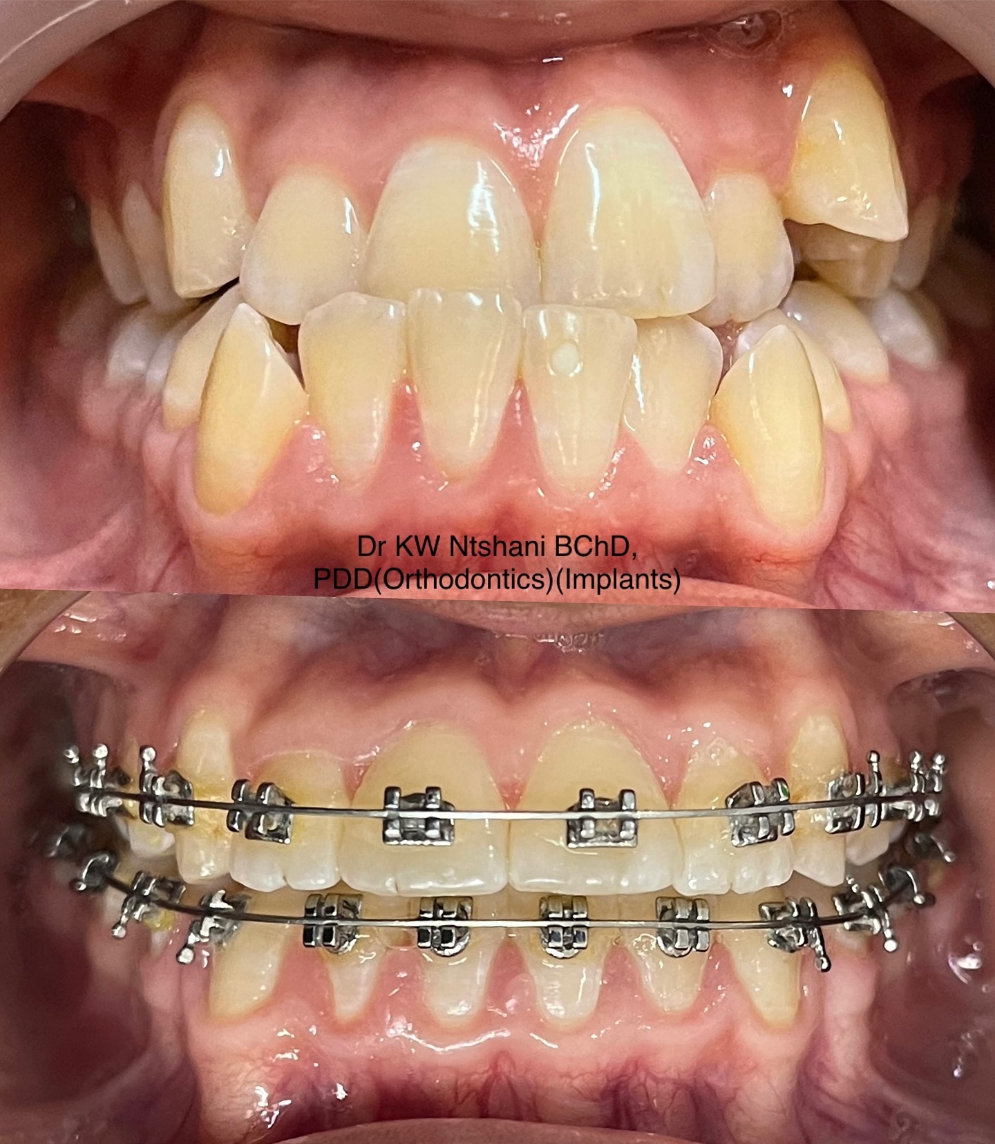 Braces transformation 9
